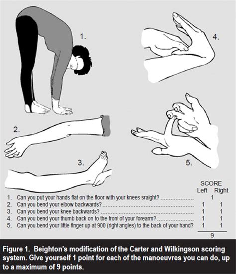 baton harding test|THE BEIGHTON SCORE How to Assess Joint Hypermobility.